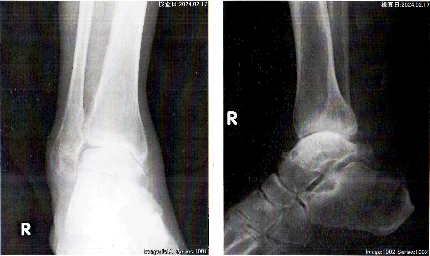 60歳代の変形性足関節症